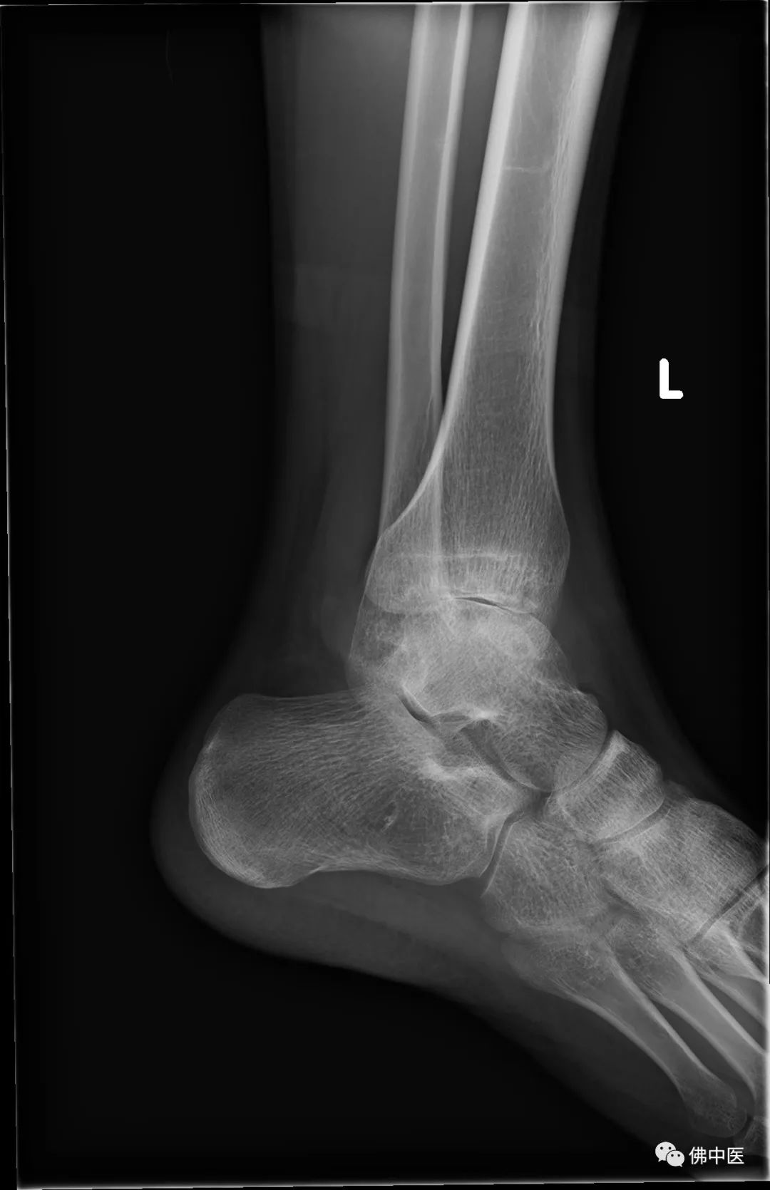 正常足部X光片,正常踝关节片子图片 - 伤感说说吧